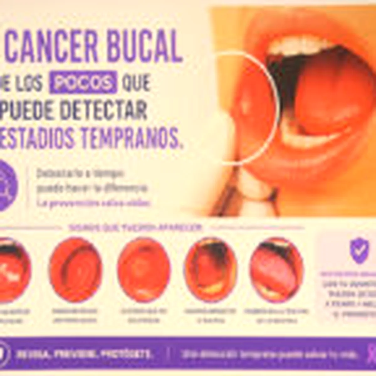 Exploración autoguiada y visitas dentales, fundamentales frente a cáncer bucal — Universidad Veracruzana
