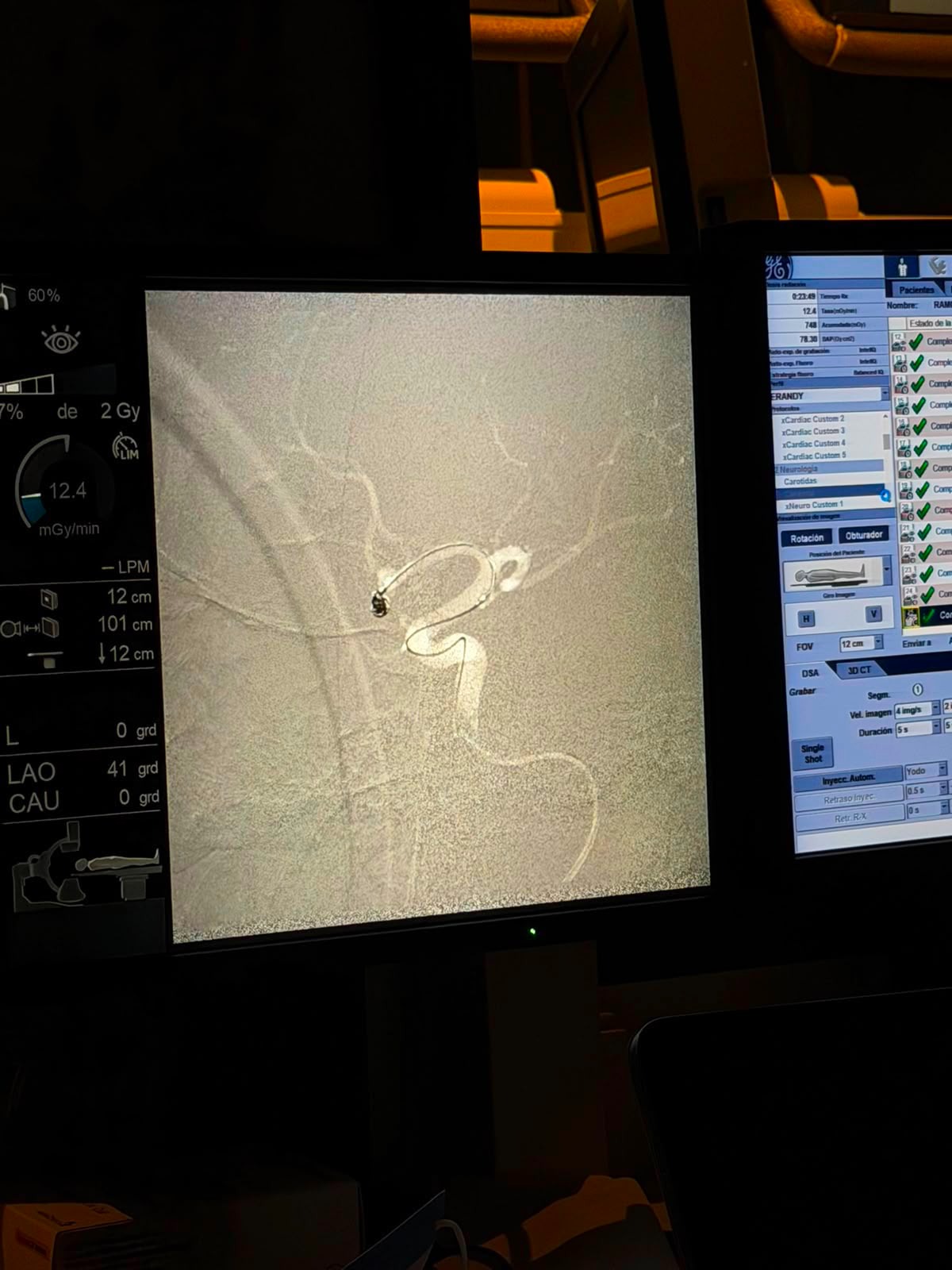 ISSSTE realiza primera neurointervención endovascular en Veracruz